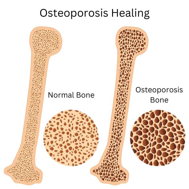 Osteoporosis Healing
